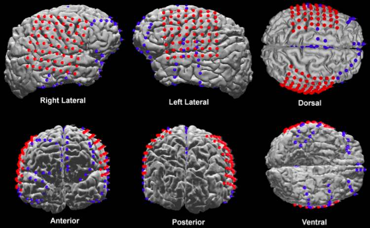 Yang, A.I., et al. Localization of dense intracranial electrode arrays using magnetic resonance imaging. Neuroimage. Oct 15, 2012.